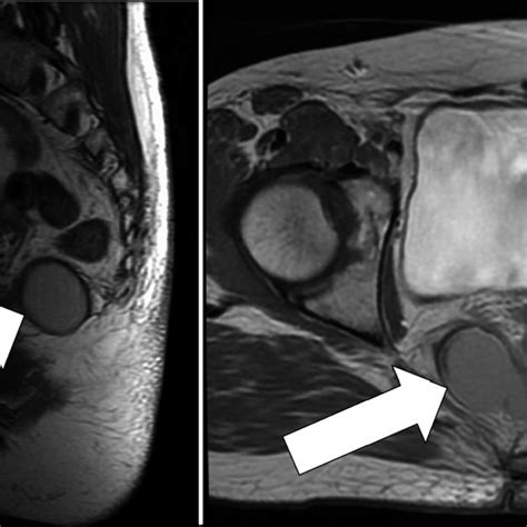 Axial Ct Duplication Cyst On Right With Wide Communication With Rectum Download Scientific