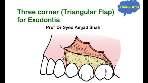 Three Corner Triangular Flap For Exodontia Oral Maxillofacial