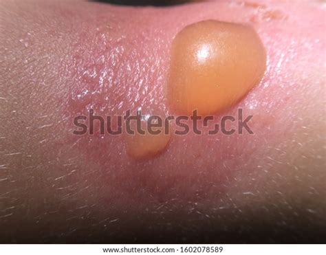 Sunburn Texture Child Skin Stock Photo Edit Now 1602078589