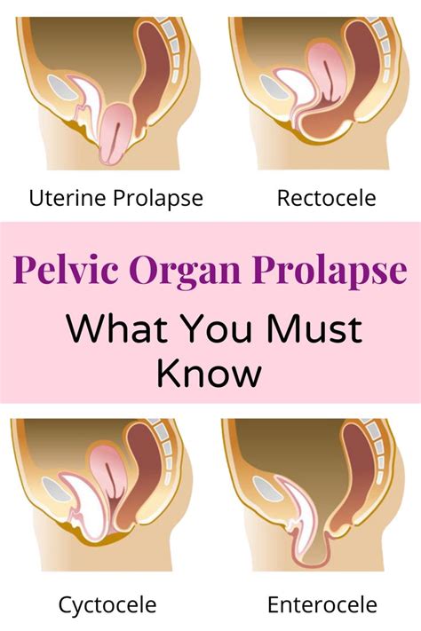 Everything You Need To Know About Pelvic Organ Prolapse In