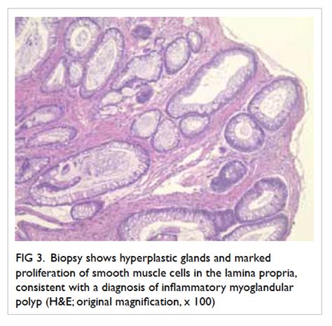 Pathology Outlines Inflammatory Myoglandular Polyp Of Colon