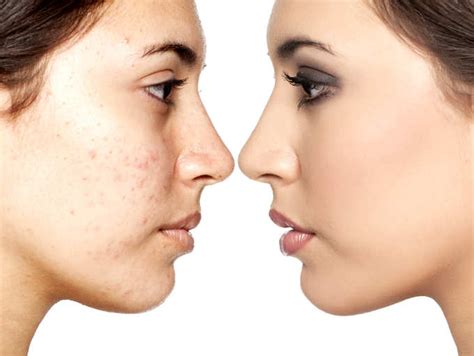 4 Types Of Blemishes And How To Stop Them