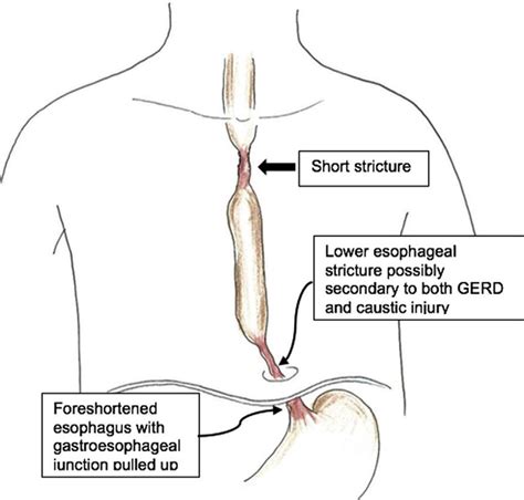 Esophageal Stricture Medical Junction