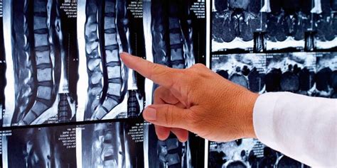 Lumbar Lordosis Flattened What It Is Causes Symptoms