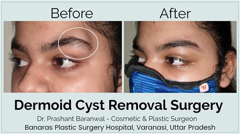 Dermoid Cyst Removal Surgery Varanasi Dermoid Cyst Of Eyebrow