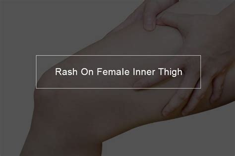 What causes rashes inside thigh? What STD causes a rash on inner thigh ...