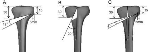Biomechanical Evaluation Of Combined Proximal Tibial Osteotomy For