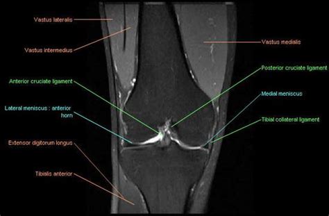 Involved early gray = muscle: Knee Mri Anatomy - Anatomy Drawing Diagram