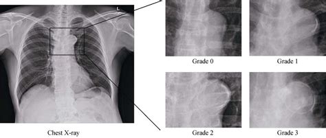 Assessment Of Aortic Arch Calcification From Chest X Rays Download