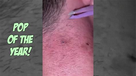 Pimple Popping Year In Review Biggest Pimples Cysts And Abscesses Youtube