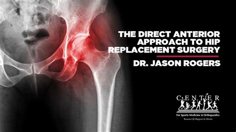 Direct Anterior Hip Replacement Anatomy