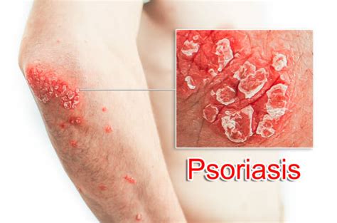 Psoriasis Symptoms Causes Diagnosis Prevention And Treatment Jyoti