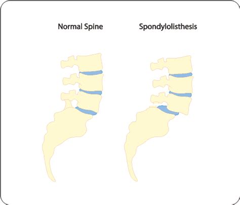 Spondylolisthesis Symptoms Causes And Treatment Anssi Wellness