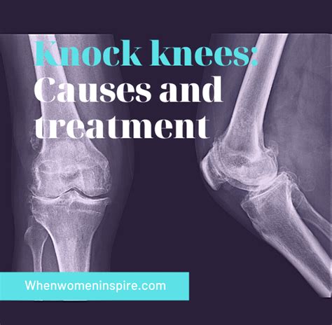 Knock Knees Causes And Treatment Options Including Yoga When Women