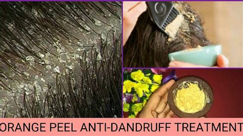 Orange Peel Anti Dandruff Treatmentremove Dandruff Easily
