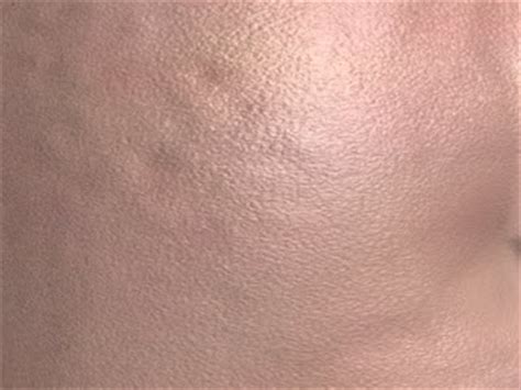 Keratosis pilaris (kp) known colloquially as. AJ's Face: Improving the skin Continued