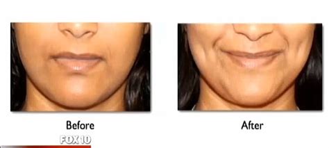 Women Are Having Dimple Surgery To Accentuate Their Grins Daily Mail Online