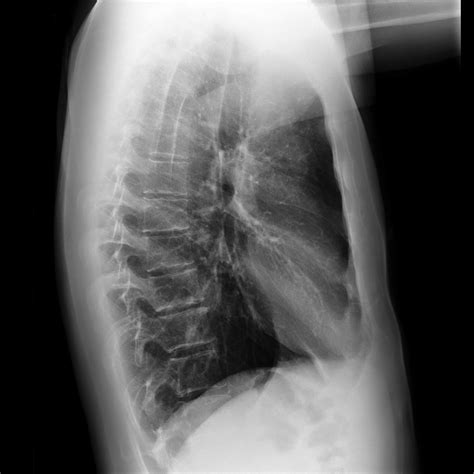 Lateral Chest X Ray Labeled