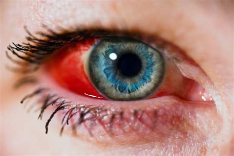 50 Subconjunctival Hemorrhage Stock Photos Pictures And Royalty Free