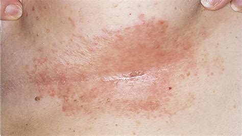Is Candidiasis Skin Contagious Home Remedies To Treat