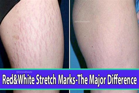 Major Differences Between Red And White Stretch Marks
