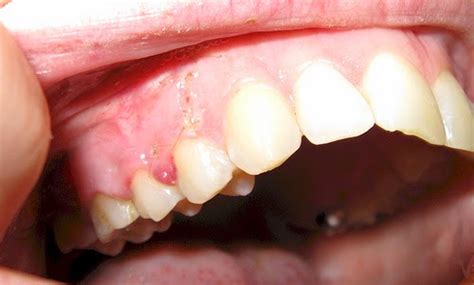Dental Cysts Causes Symptoms And Treatment Mediologiest