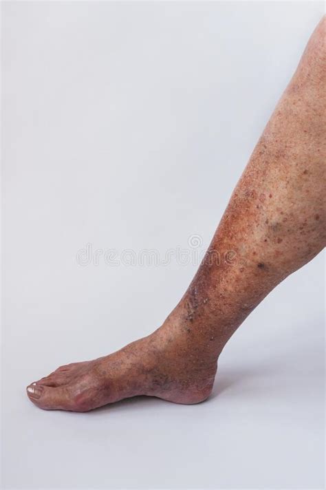 The Leg Of An Elderly Woman With Varicose Veins And Its Complications