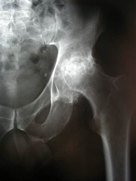 Hip Arthritis London Sports Orthopaedics