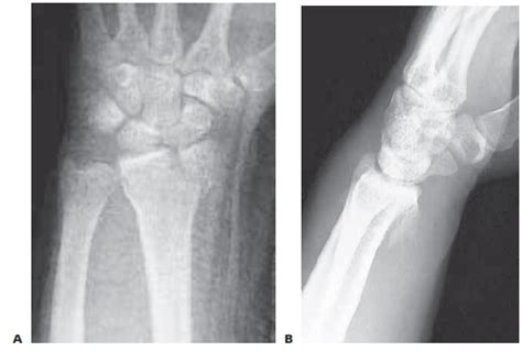 Radial Styloid Fractures