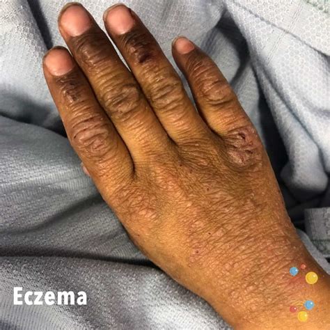Eczema Skin Deep