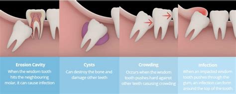Wisdom Tooth Extraction Removal In Bangkok Thailand