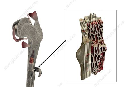 The Internal Structure Of Bone Stock Image C0082290 Science