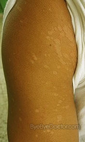 White Spots On Skin Pictures Causes And Treatment Symptoms Causes