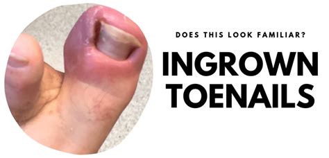 The Simple Guide To Ingrown Toenails Pod Fit Adelaide