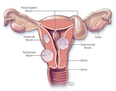 Exploring Treatment Options For Women With Fibroids