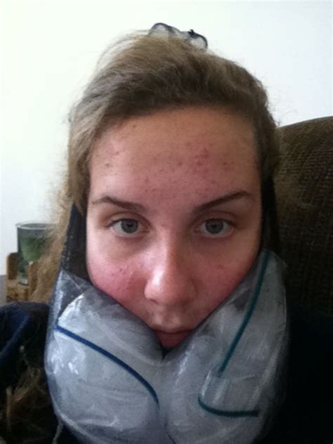 Learn about the surgery, preparation, and recovery. Should I Ice My Face After Wisdom Teeth Removal - TeethWalls