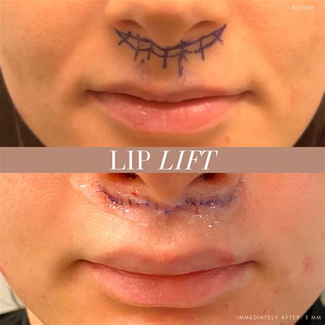 Lip Lift Before And After Lip Surgery Eyelid Surgery Asian Plastic