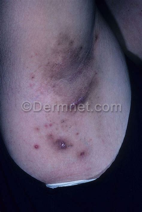 Hidradenitis Suppurativa Photo Skin Disease Pictures