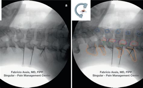 Cervical 3rd Occipital Nerve And Medial Branch Radiofrequency Ablation