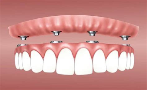 Snap In Dentures Implants Types Memphis Hernando