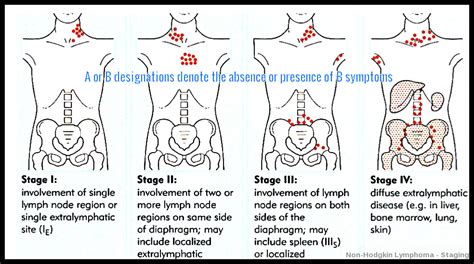 Non Hodgkin Lymphoma Ask Hematologist Understand Hematology