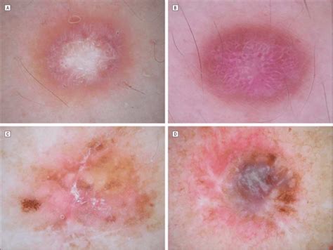 Patterns Of Dermatofibroma A Peripheral Homogeneous Pigmentation And