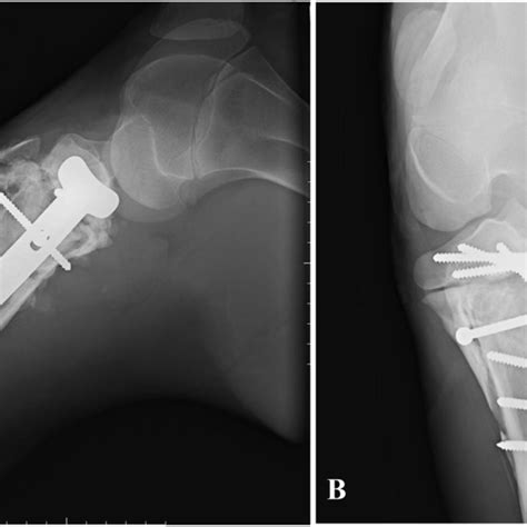 Lateral Radiograph Of The Proximal Tibia After Surgical Removal Of The