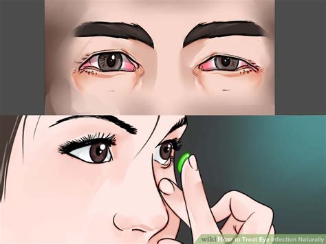 6 Ways To Treat Eye Infection Naturally Wikihow