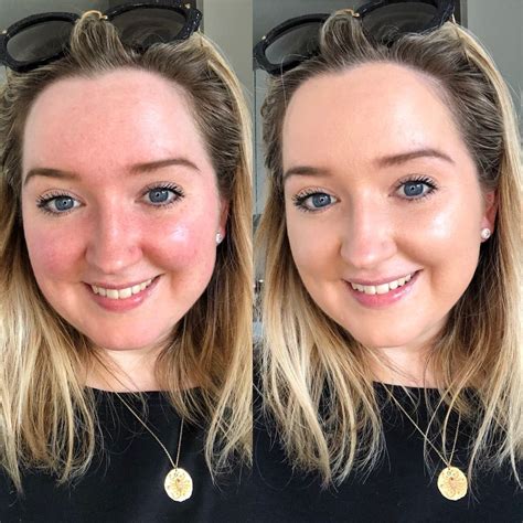 14 Redness Reducing Products I Swear By Since Being Diagnosed With Rosacea