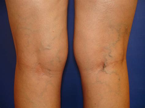 Before And After Photos Advanced Vein Care