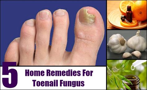 5 Tips On Home Remedy Toenail Fungus Natural Treatments And Cure For