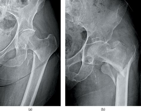 Extracapsular Proximal Femur Fractures Musculoskeletal Key
