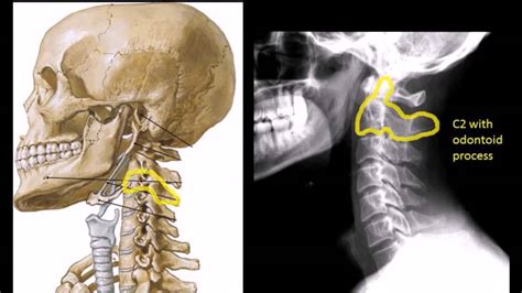 Background cervical spondylosis is one of the most common causes of cervical instability. Approach to Cervical spine xrays - YouTube