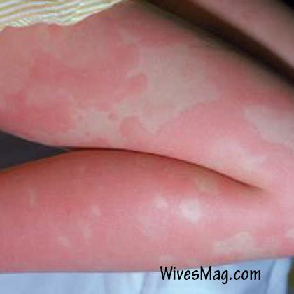 The reaction begins when the excess histamine causes an extreme inflammatory response, or an allergic reaction. Symptoms, Causes, Home remedies & treatments for Urticaria ...